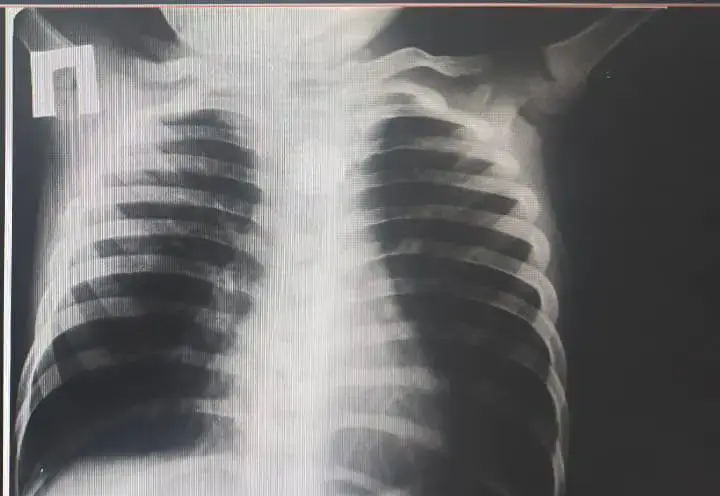 В Туркестане хирурги спасли жизнь ребенку, проглотившему батарейку Астане