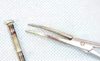 Международные врачи Туркестанской областной детской больницы успешно провели операцию по извлечению болта из горлянки 1-летнего ребенка