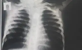 В Туркестане хирурги спасли жизнь ребенку, проглотившему батарейку