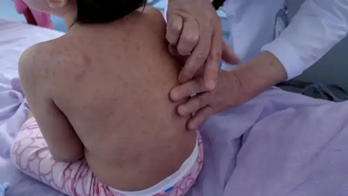 Дети продолжают поступать в столичные больницы с корью: врачи обратились к родителям (3)