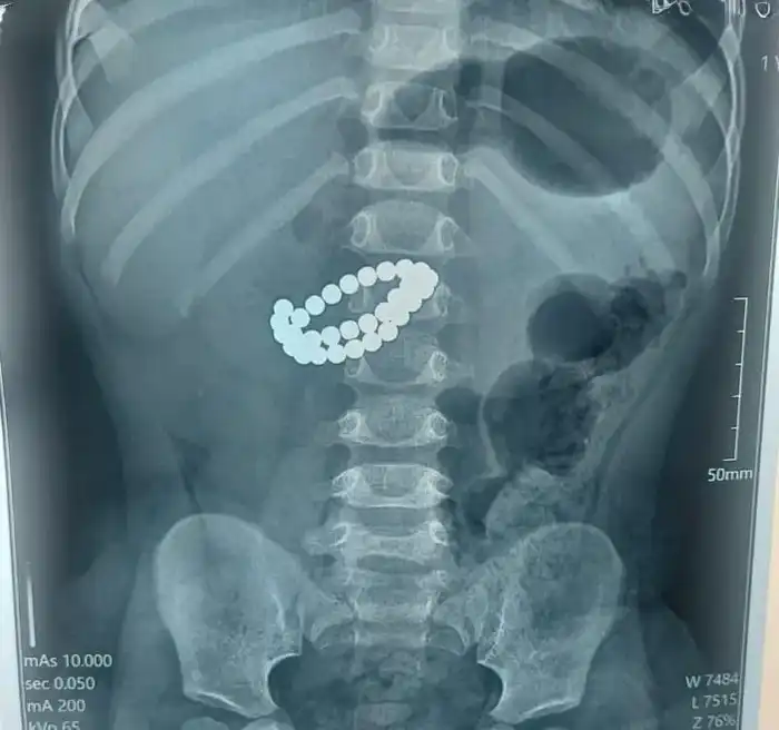 Опасность магнитных игрушек: случай с ребенком в Алматы подчеркивает необходимость родительского контроля Астане