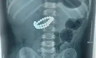 Опасность магнитных игрушек: случай с ребенком в Алматы подчеркивает необходимость родительского контроля